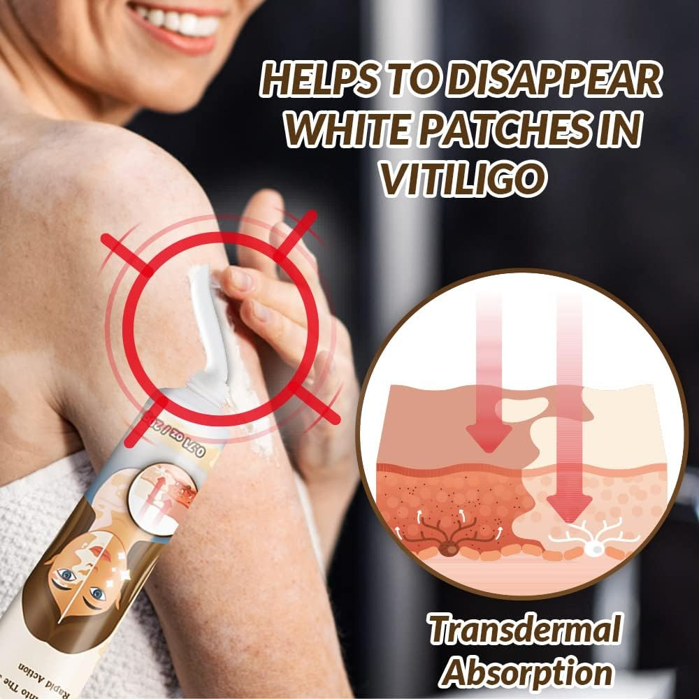 Natural Vitiligo Cream
