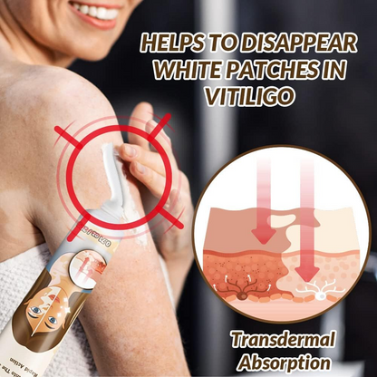 Natural Vitiligo Cream